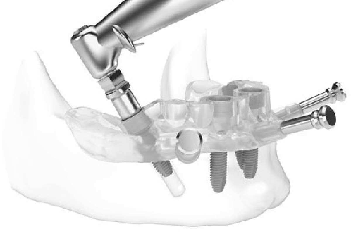 Digital Implantology